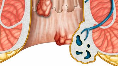 علاج البواسير الداخلية