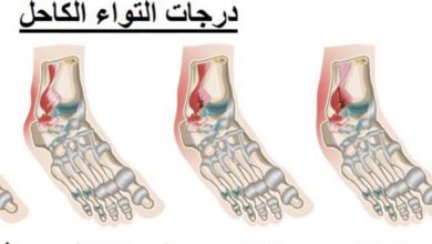 علاج التواء القدم