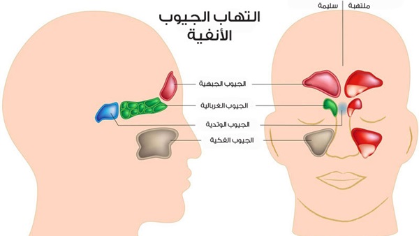 افضل علاج لحساسية الجيوب الانفية