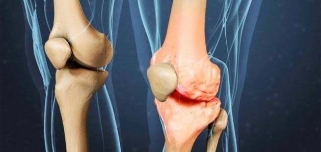 علاج آلام الركبة بالأدوية والجراحة