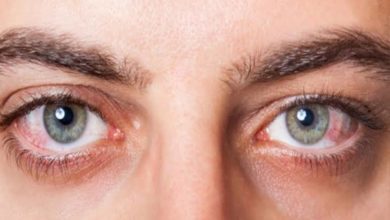 علاج احمرار العين