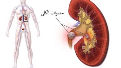 علاج الحصوات