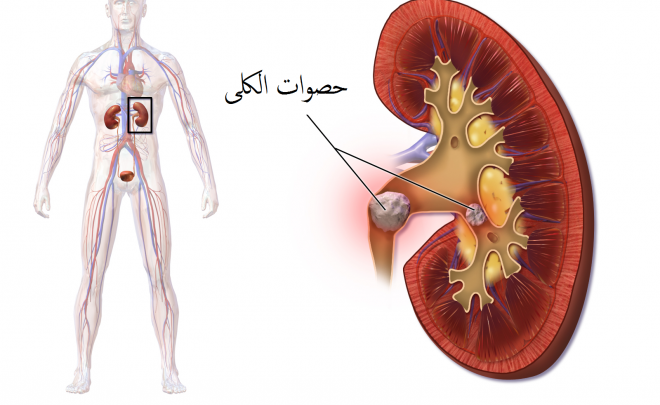 علاج الحصوات