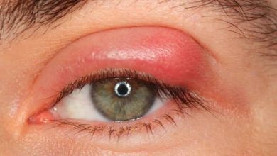 علاج الكيس الدهني في العيون