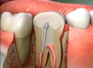 علاج الم عصب الاسنان بالبيت