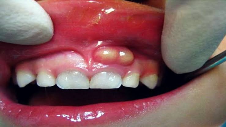 علاج خراج الاسنان بالمضاد الحيوي
