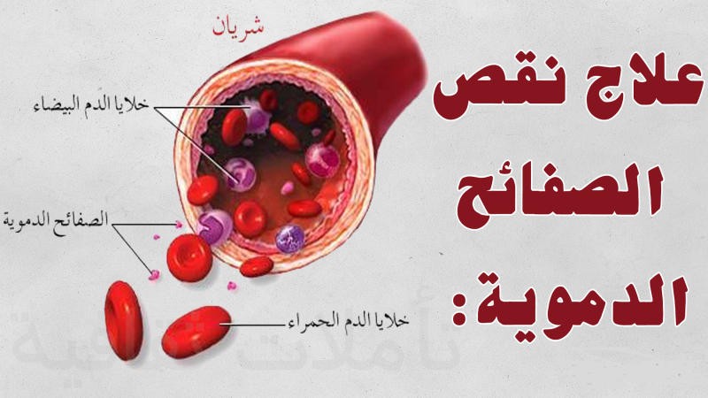 علاج نقص الصفائح الدموية