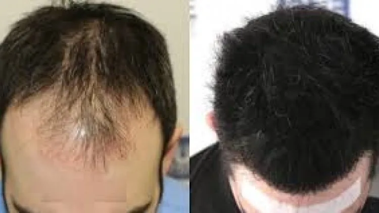  عملية زراعة للشعر