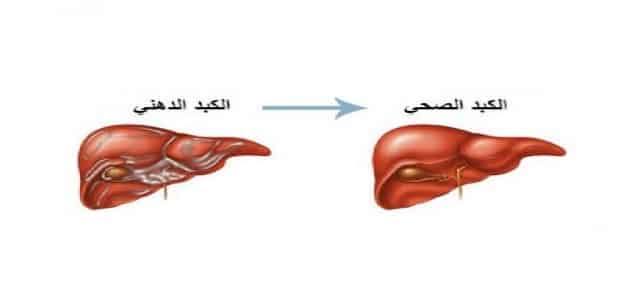 مشكلة الدهون على الكبد والكبد الدهني