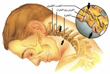 أعراض اصابة الرقبة