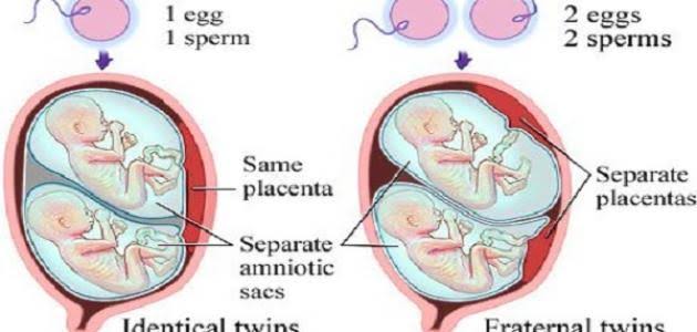 أنواع الحمل بتوأم