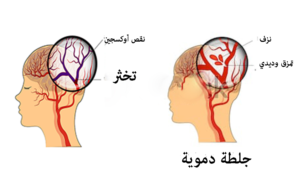 اعراض الجلطة الدماغية وأنواعها