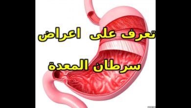 اعراض سرطان المعدة