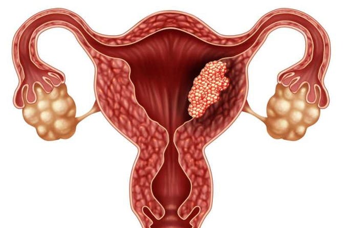 الافرازات المصحوبة بالدماء و الآلام في اسفل البطن من اهم علامات سرطان الرحم