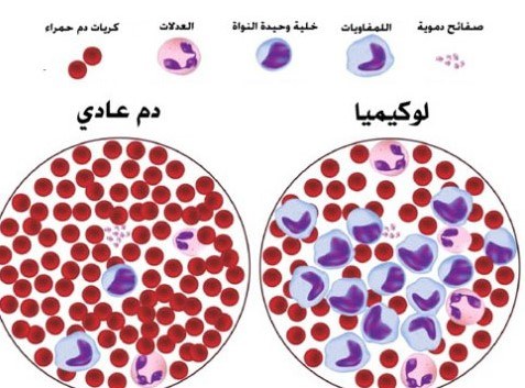 الفرق بين خلايا الدم السليمة و خلايا الدم السرطانية