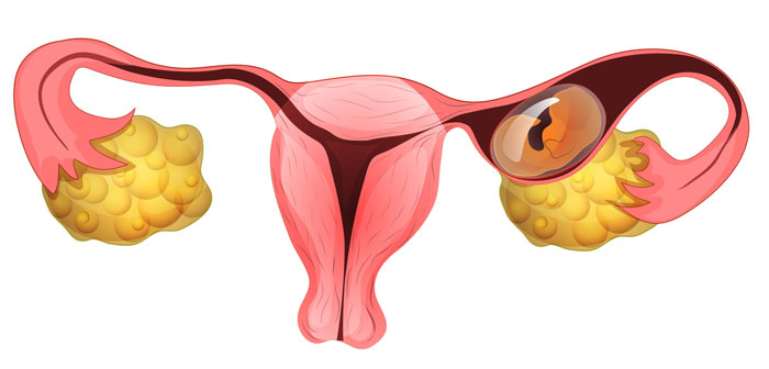 صورة توضح كيف يكون الحمل خارج الرحم