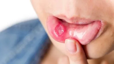فطريات الفم