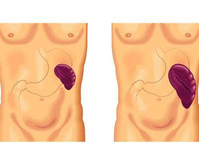 علاج تضخم الطحال