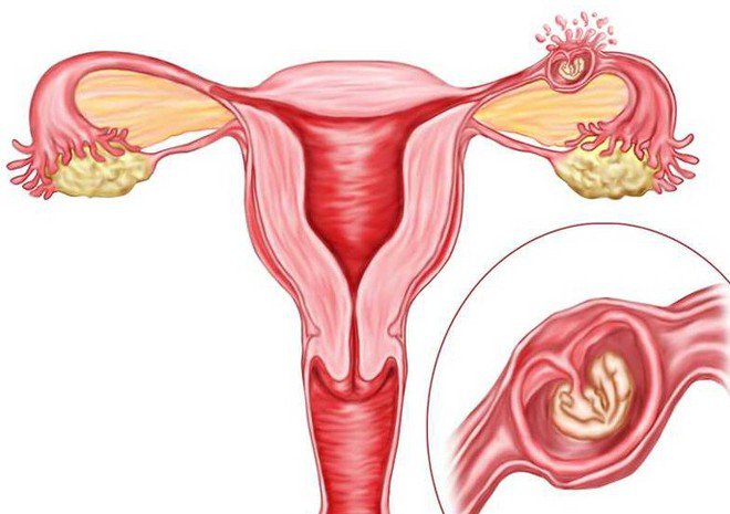 اذا تم اهمال الحمل خارج الرحم قد يحدث نزيف حاد يؤدي الى الوفاة