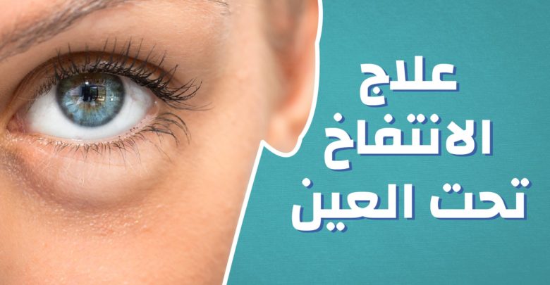 اسباب و علاج الانتفاخ تحت العين