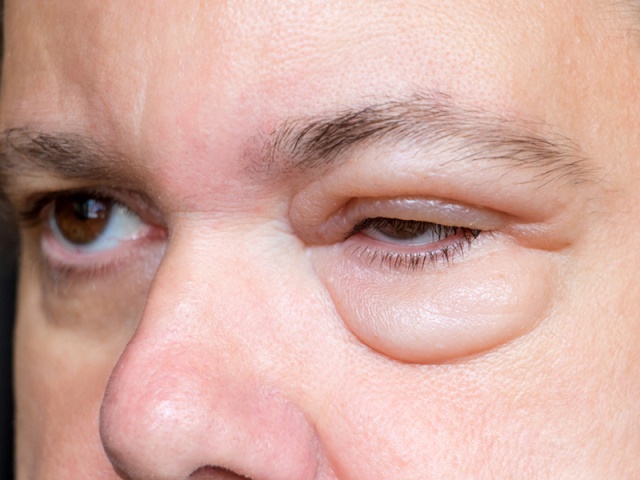انتفاخ تحت العين قد يكون دليل على مرض معين و يمكن ان يكون طبيعيا