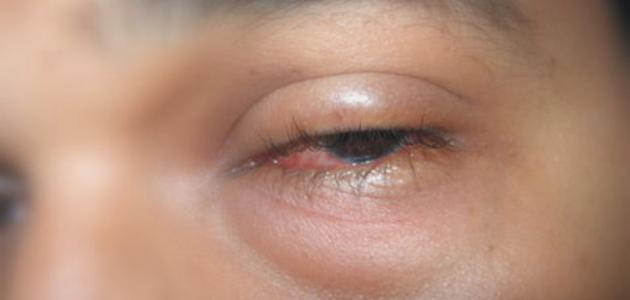 اهمال الانتفاخ تحت العين قد يؤدي الى فقدان البصر
