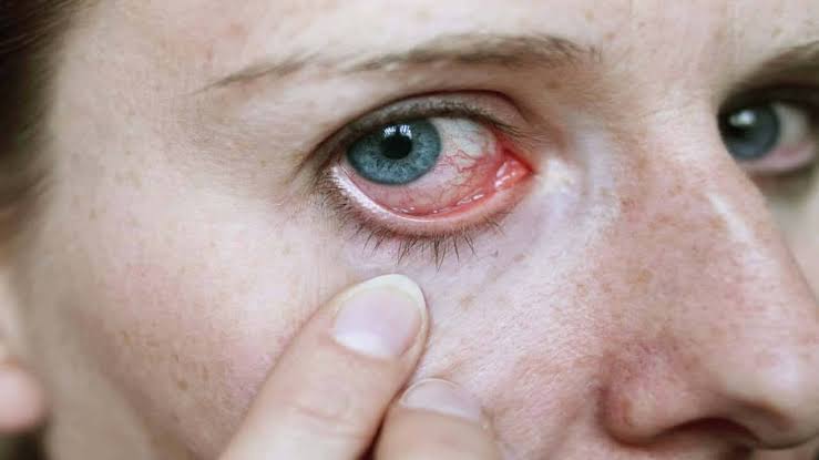 دواء ايريوس مفيد ايضا للتخلص من حساسية العين