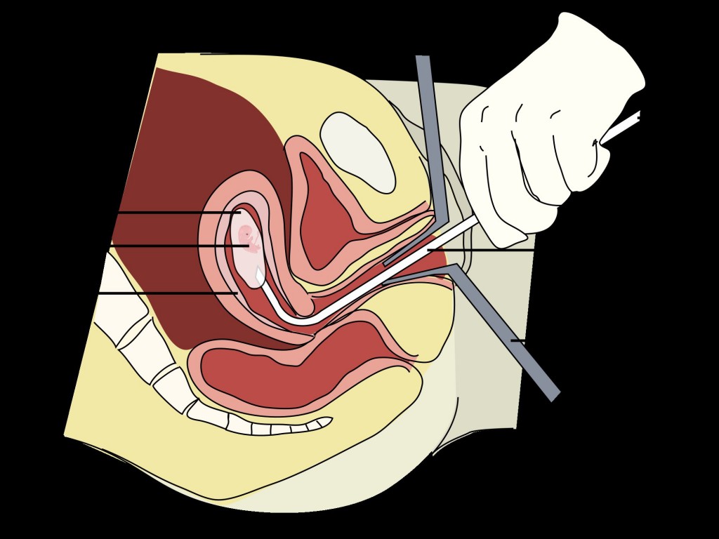 عند حدوث الاجهاض يجب اجراء عملية تنظيف للرحم