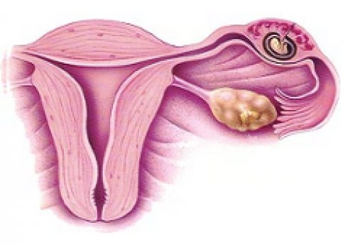 من اهم علامات الحمل خارج الرحم الشعور بآلام حادة اسفل البطن