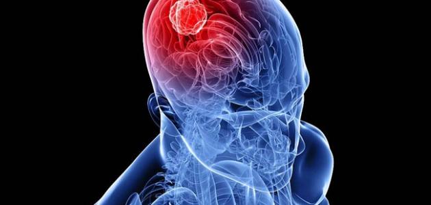 اعراض الورم في الدماغ لا تظهر الا في مراحل متأخرة