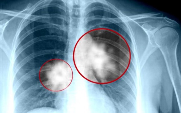  اعراض سرطان الرئة المتقدمة 