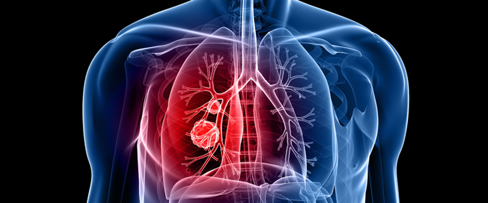  اعراض سرطان الرئة المتقدمة 