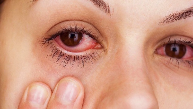 يمكن استعمال الدواء كذلك من اجل علاج حساسية العين