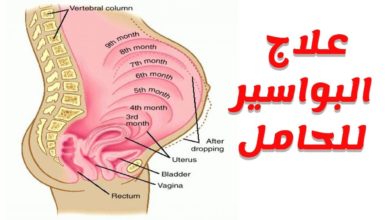 علاج البواسير للحامل