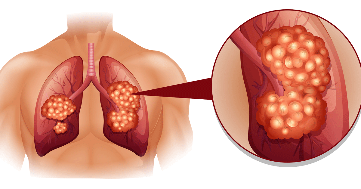 اعراض سرطان الرئة