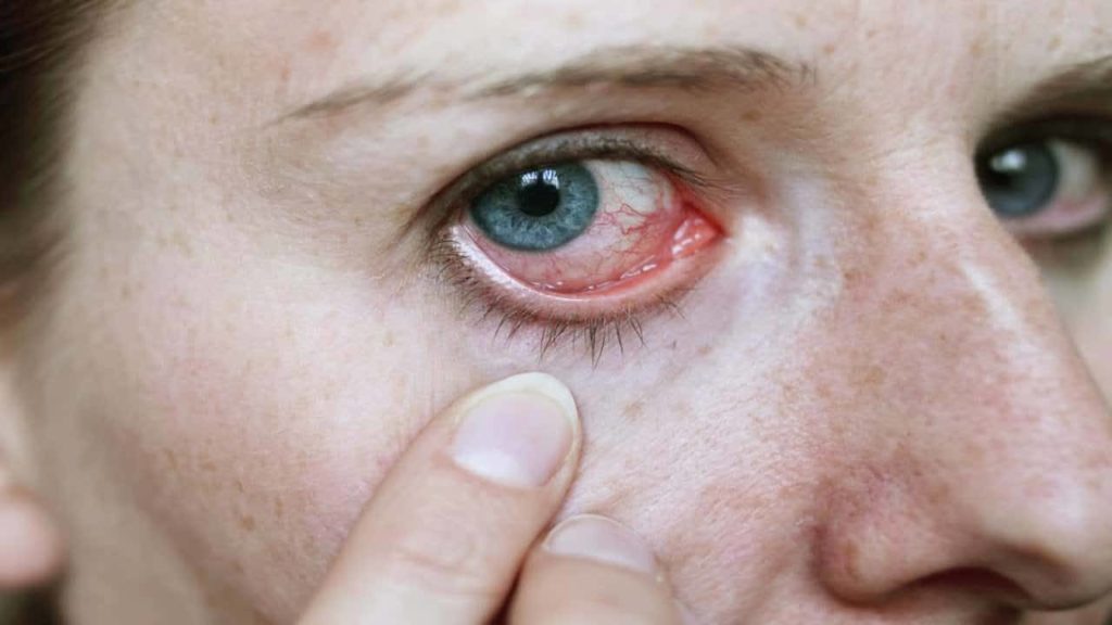 يمكن لدواء كلاريتين ايضا ان يعالج حساسية العين