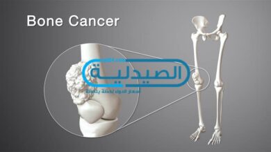 سرطان العظام و الكيماوي