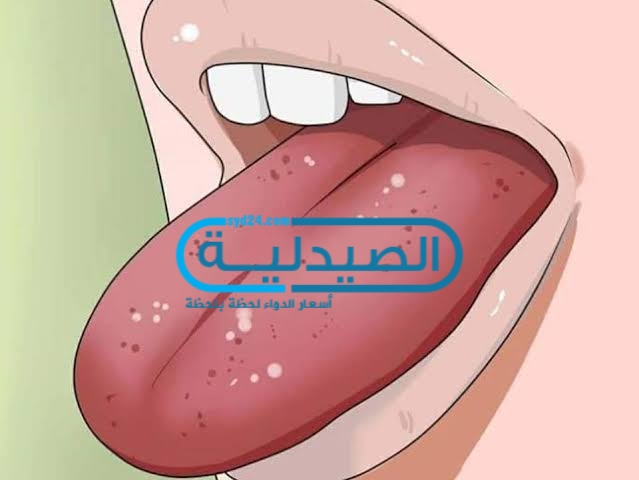 علاج الفطريات