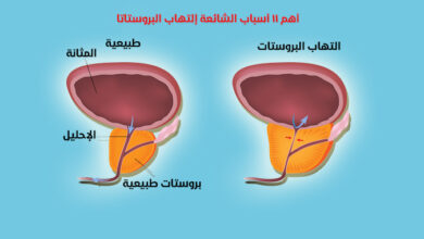 اعراض التهاب البروستاتا وأنواعها