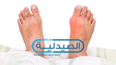 أسباب النقرس