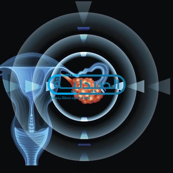 علاج سرطان المبيض