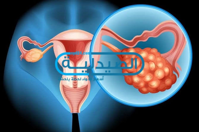 علاج سرطان المبيض