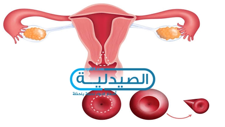 علاج سرطان عنق الرحم