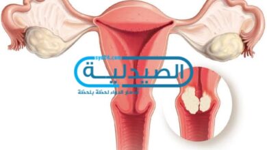 علاج سرطان عنق الرحم