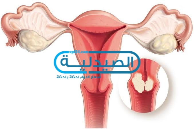 علاج سرطان عنق الرحم