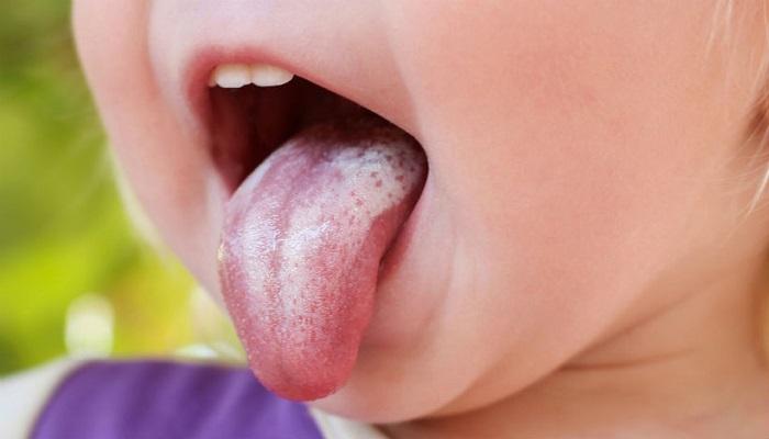 فطريات الفم عند الرضع