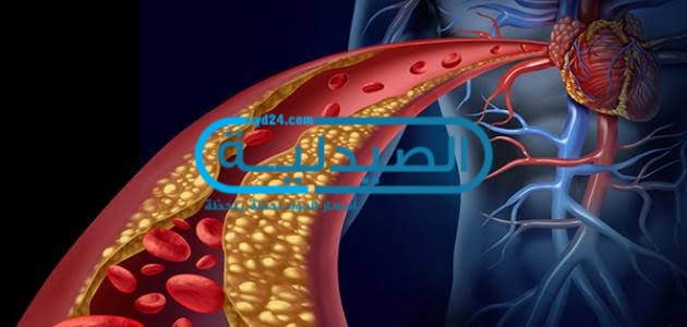 أسباب ارتفاع نسبة الكوليسترول في الدم