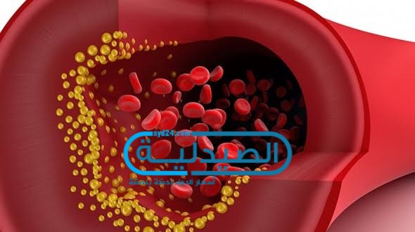 علاج ارتفاع نسبة الكوليسترول في الدم