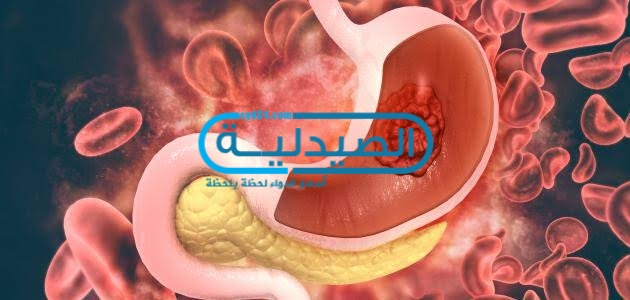 الوقاية من سرطان المعدة