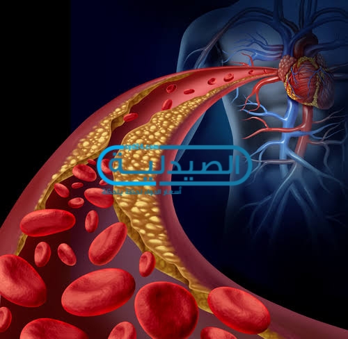 علاج ارتفاع نسبة الكوليسترول في الدم